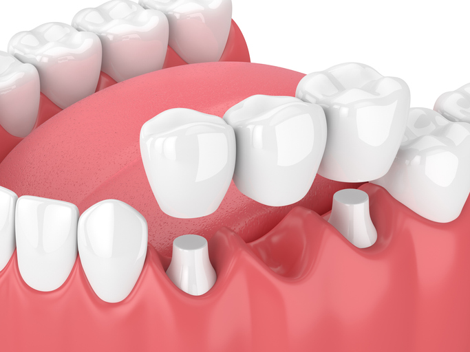 3d render of jaw with dental bridge